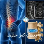 دیسک کمر خفیف