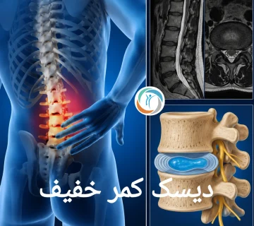 دیسک کمر خفیف