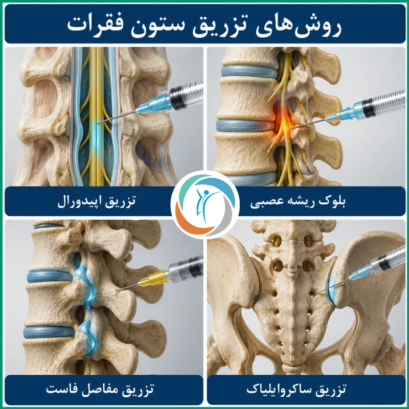 روش های تزریق ستون فقرات؛ تزریق برای کمردرد