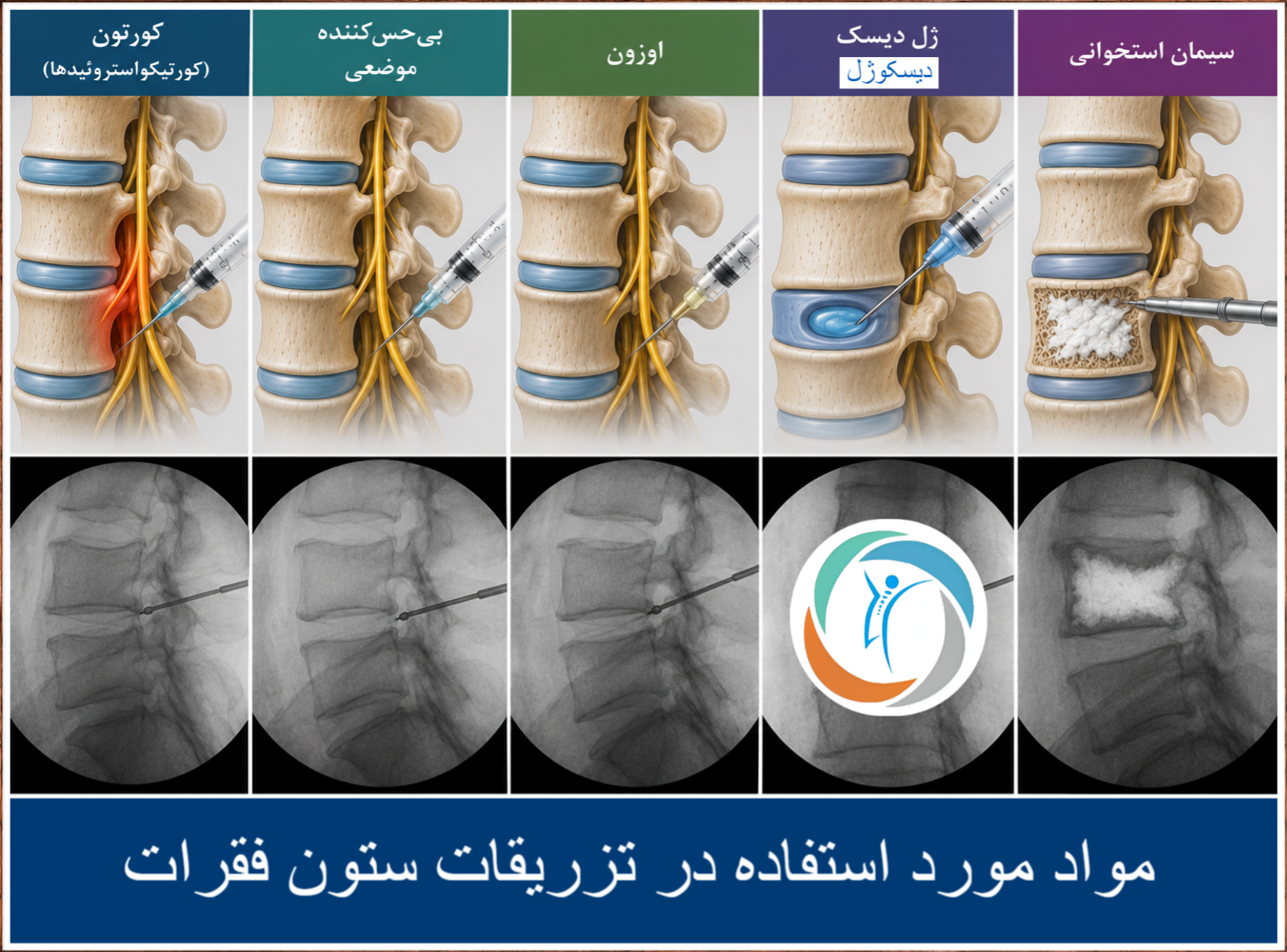 مواد مورد استفاده در تزریقات ستون فقرات