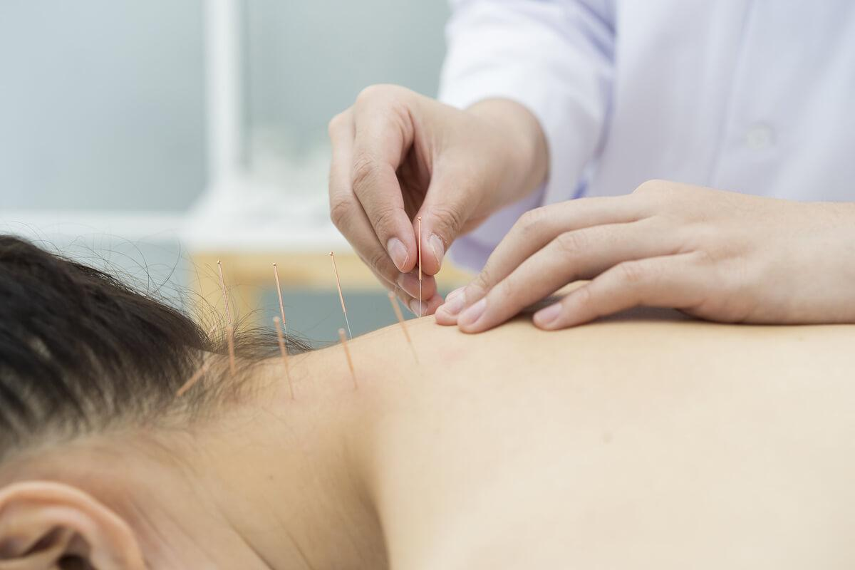 طب سوزنی برای آرتروز گردن