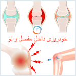 خونریزی داخل مفصل زانو