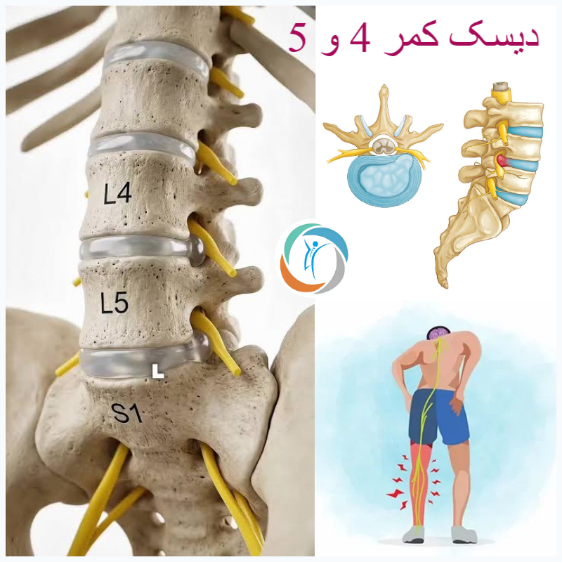 دیسک کمر مهره 4 و 5