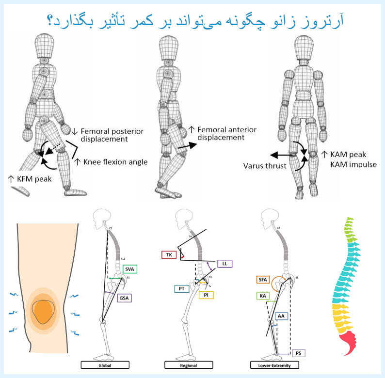 آرتروز زانو چگونه می‌تواند بر کمر تأثیر بگذارد؟