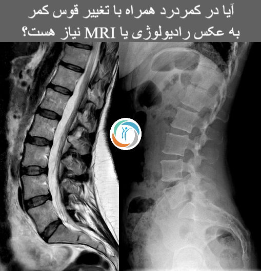 آیا برای کمردرد و تغییر قوس کمر به عکس یا  ام آر آی نیاز هست؟