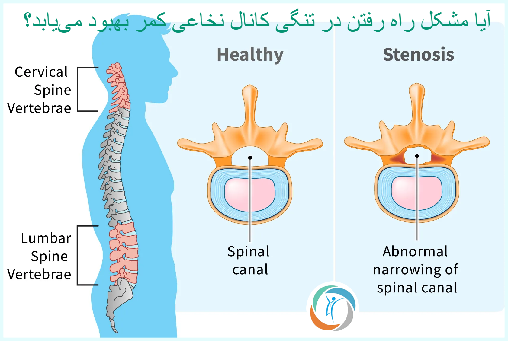 آیا مشکل راه رفتن در تنگی کانال نخاعی کمر بهبود می‌یابد؟