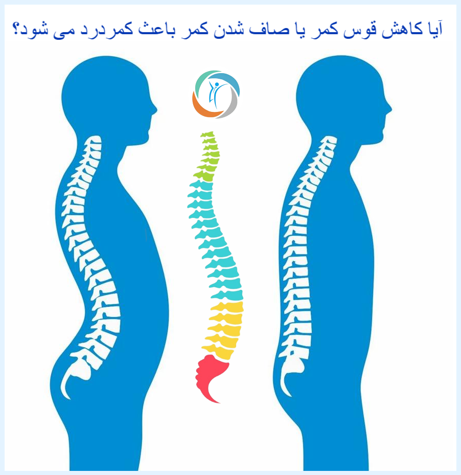آیا کاهش قوس کمر یا صاف‌شدن کمر باعث کمردرد می‌شود؟