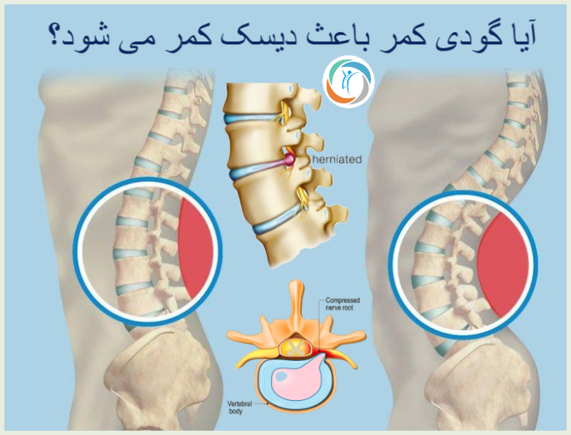 آیا گودی کمر باعث دیسک کمر می شود؟