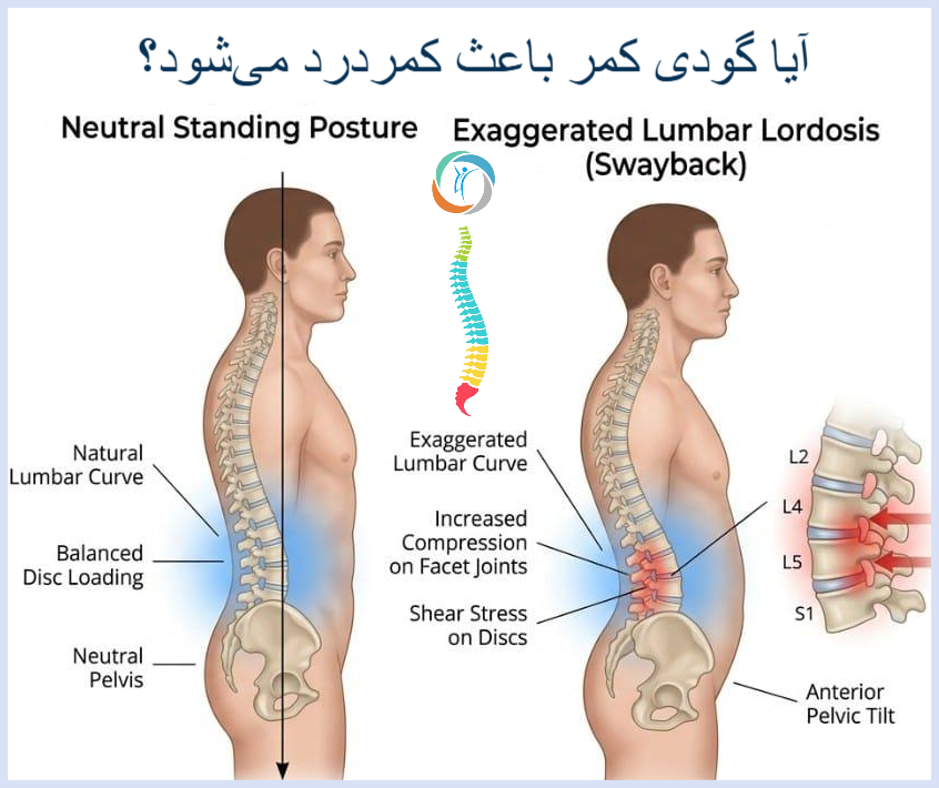 کمردرد در گودی کمر؛ آیا گودی کمر باعث کمردرد می‌شود؟