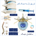 تزریق ژل به دیسک کمر چیست؟