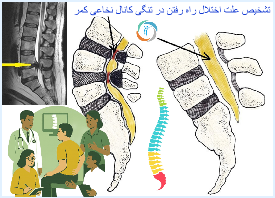 تشخیص علت اختلال راه رفتن در تنگی کانال نخاعی کمر