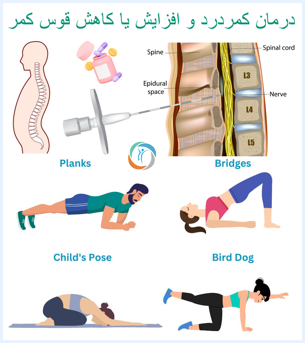 درمان کمردرد و افزایش یا کاهش قوس کمر