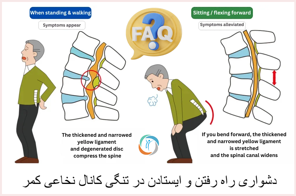 سوالات متداول درباره مشکل راه رفتن در تنگی کانال نخاعی کمر