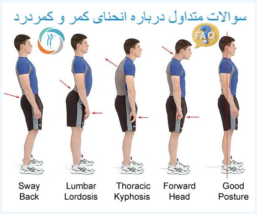 سوالات متداول انحنای کمر و کمردرد