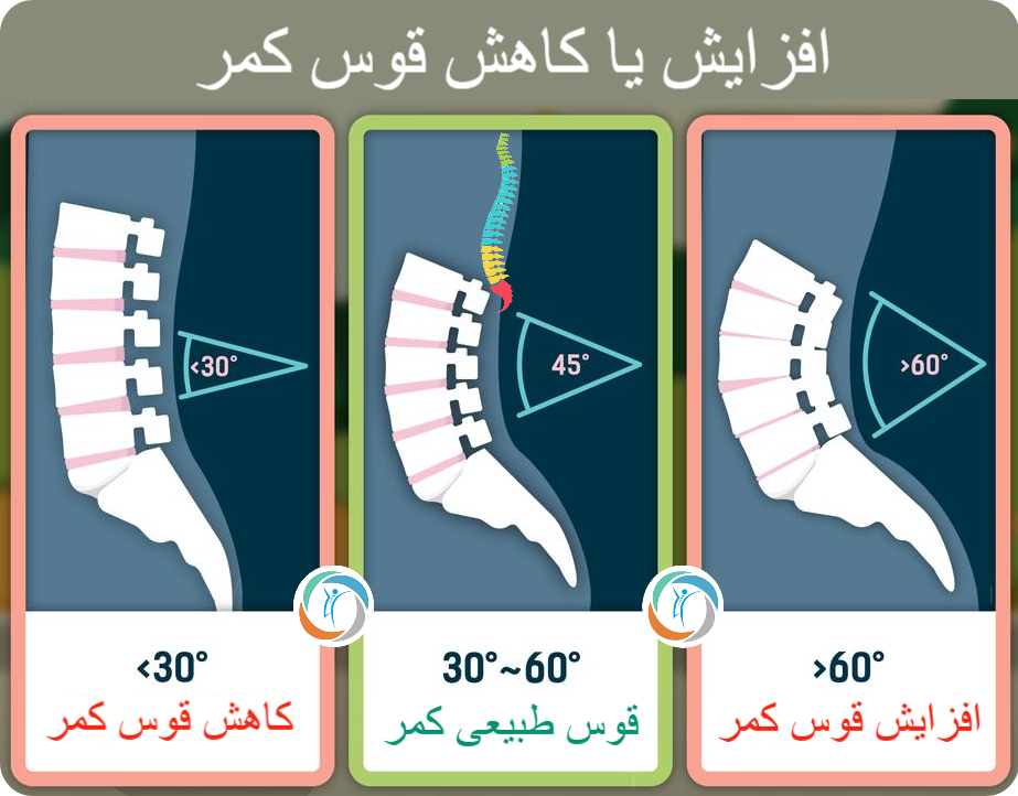قوس طبیعی، افزایش یا کاهش قوس کمر