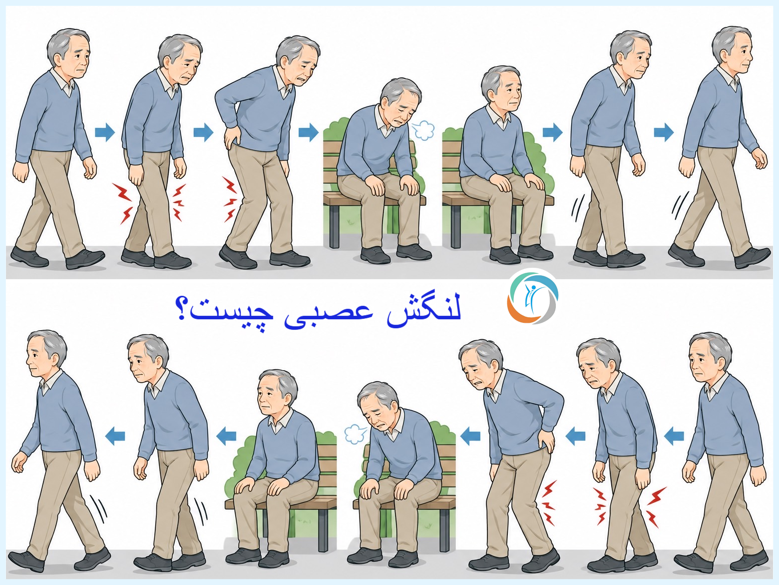 لنگش عصبی چیست؟