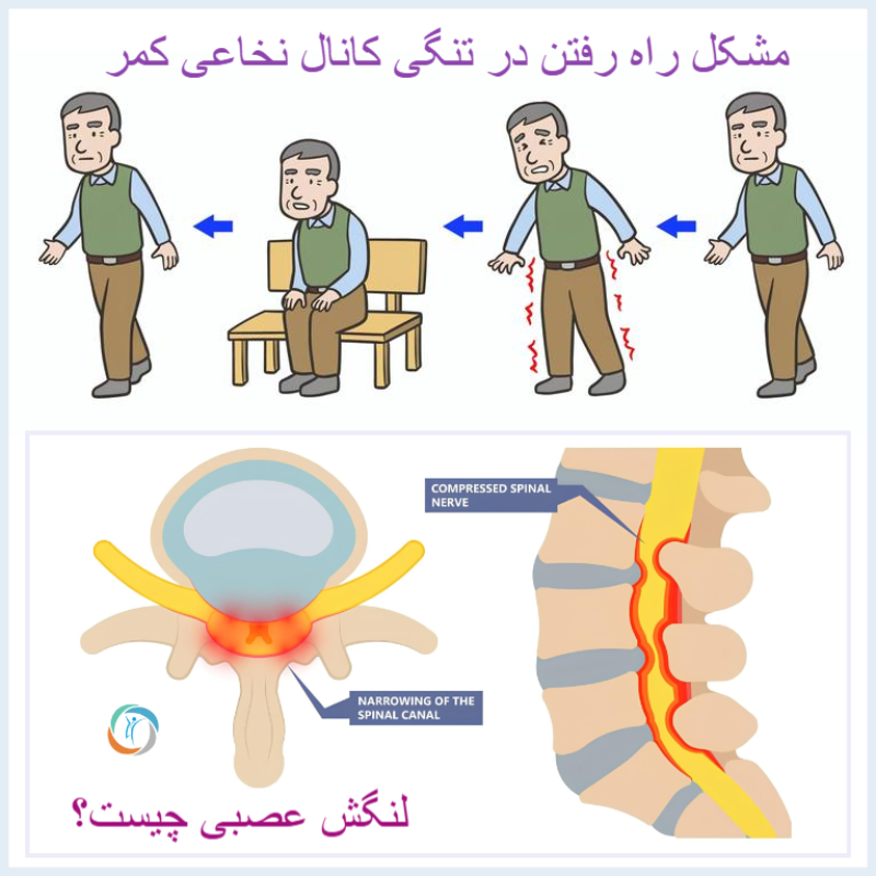 مشکل راه رفتن در تنگی کانال نخاعی کمر