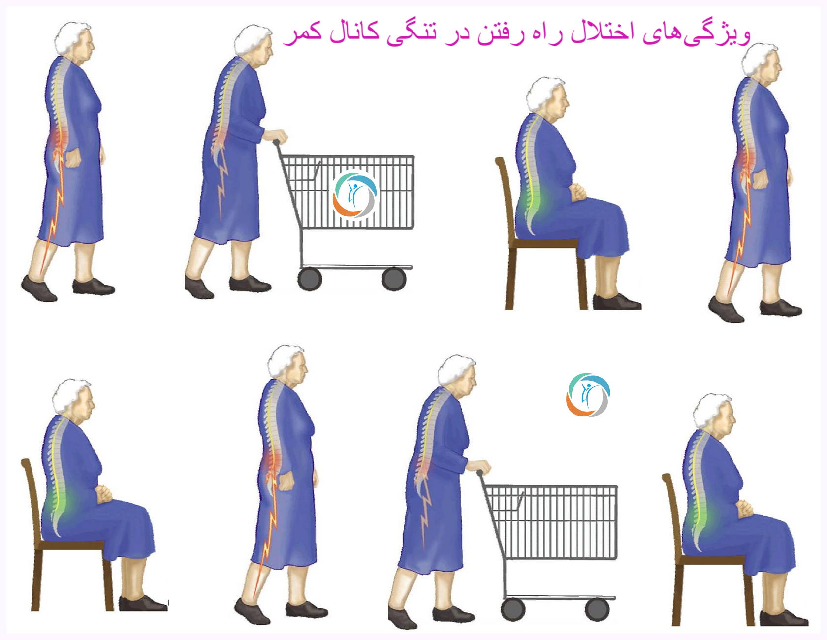 ویژگی‌های اختلال راه رفتن در تنگی کانال کمر