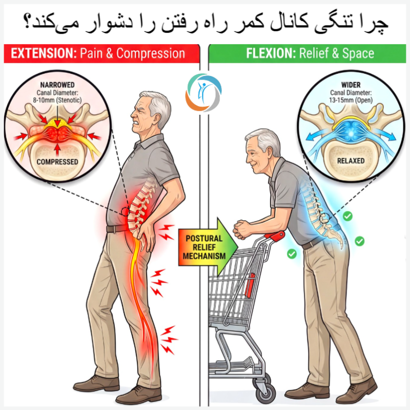 چرا تنگی کانال کمر راه رفتن را دشوار می‌کند؟