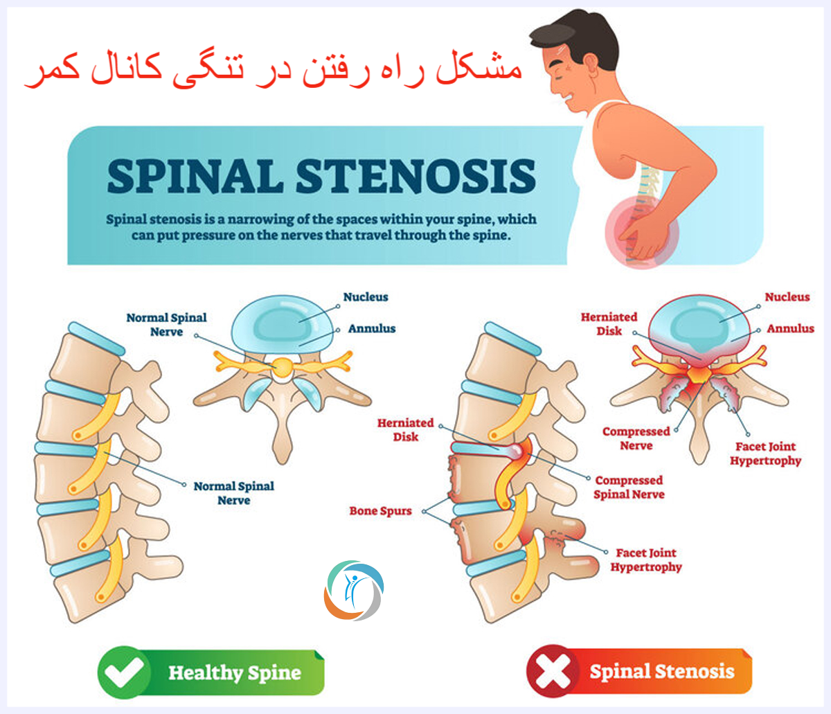 چه زمانی مشکل راه رفتن در تنگی کانال نخاعی کمر نگران‌کننده است؟