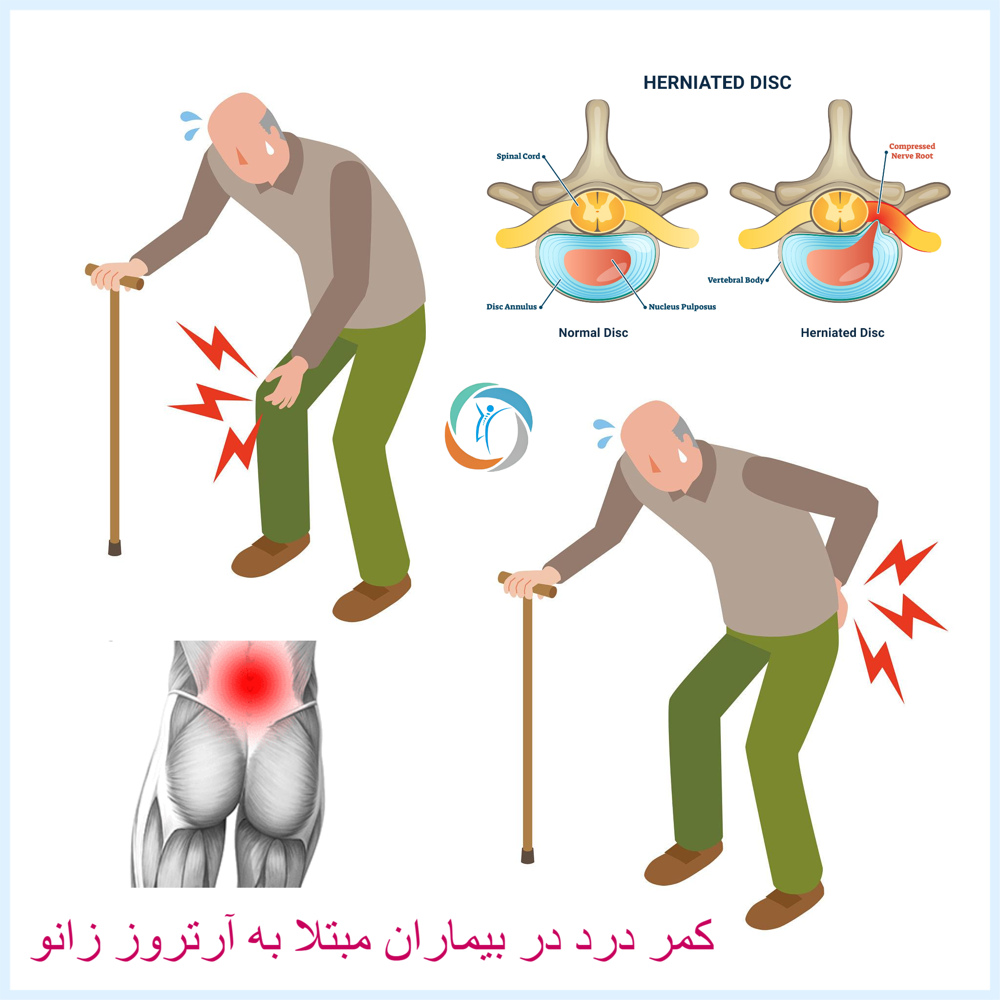 کمر درد در بیماران مبتلا به آرتروز زانو