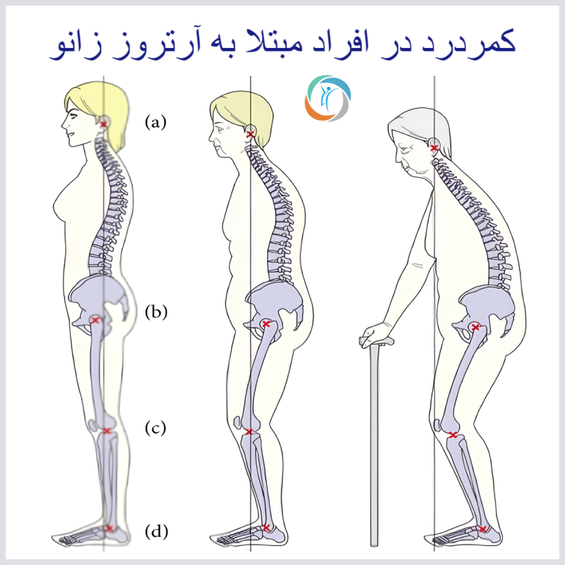 کمردرد در افراد مبتلا به آرتروز زانو