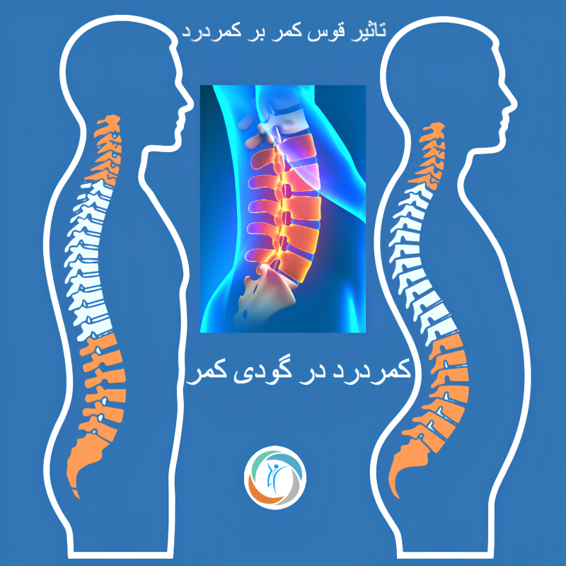 کمردرد در گودی کمر